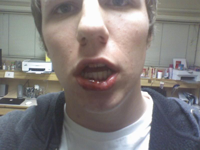 Punched in the lip PICS