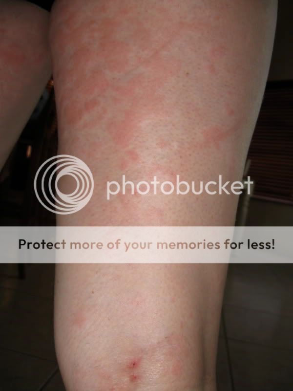 Quick! Need rash advice (pics included) - Mothering Forums